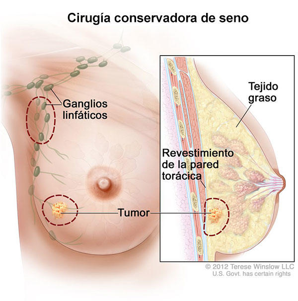 dolor de espalda por cancer de seno dolor de espalda por cancer de seno